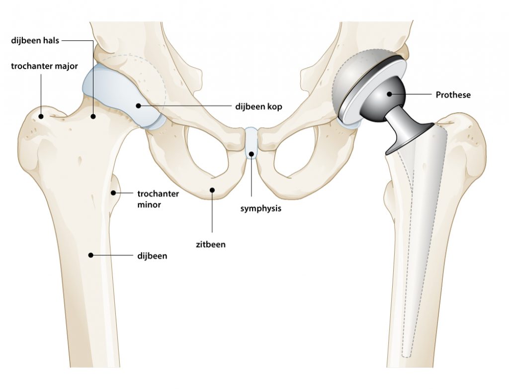 Afbeelding heup en heupprothese
