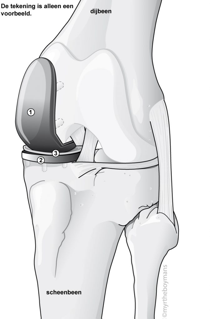Afbeelding halve knieprothese